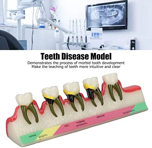 DentesDiseEMEModel, Educational DentalPathologicalModel Englishwords para DentalColleges