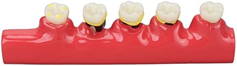 Modelo de doenças dentárias, Patologia Dental Modelo Educacional Sólido para Universidades Dentárias