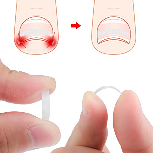60 peças encravar as unhas da unha do pé de correção encravada da unhora da unha do unha do unha de correção do unho